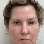 Sculptra Before & After Patient #4049