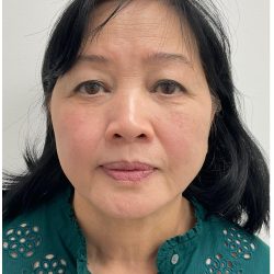 Kybella Before & After Patient #3996