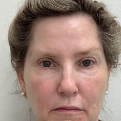 Sculptra Before & After Patient #4049