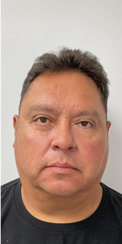 Lower Blepharoplasty Before & After Patient #4044
