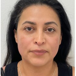 XERF Before & After Patient #4058