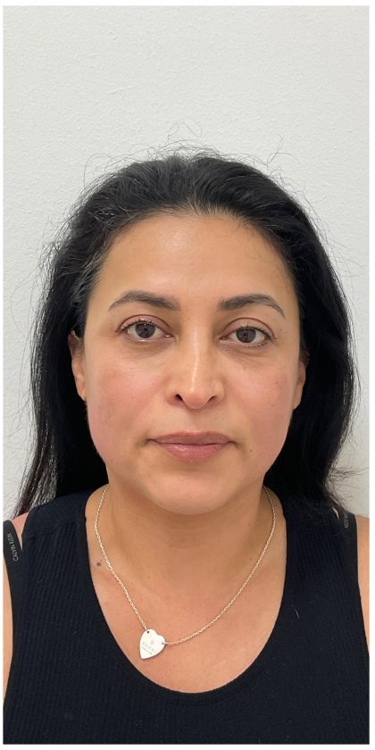XERF Before & After Patient #4058