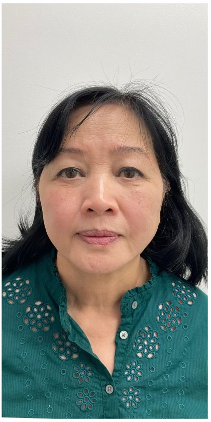 Kybella Before & After Patient #3996