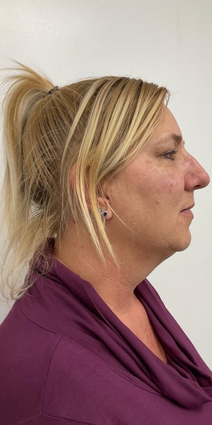 Kybella Before & After Patient #4092