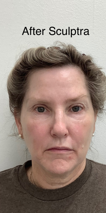 Sculptra Before & After Patient #4049