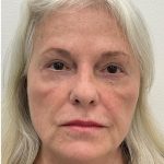 Lower Blepharoplasty Before & After Patient #4074