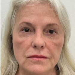 Lower Blepharoplasty Before & After Patient #4074
