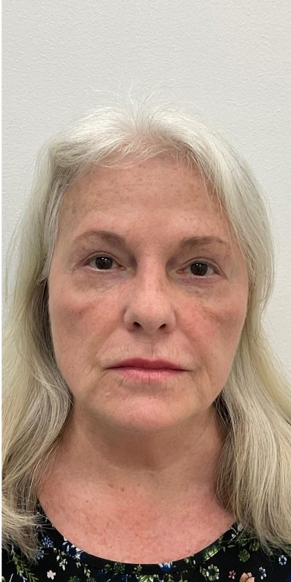 Lower Blepharoplasty Before & After Patient #4074