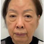 Lower Blepharoplasty Before & After Patient #4114