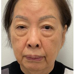 Lower Blepharoplasty Before & After Patient #4114