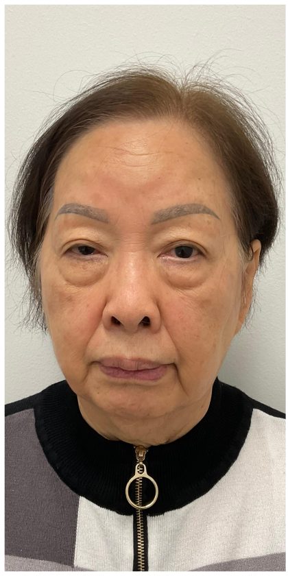 Lower Blepharoplasty Before & After Patient #4114