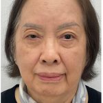 Lower Blepharoplasty Before & After Patient #4114