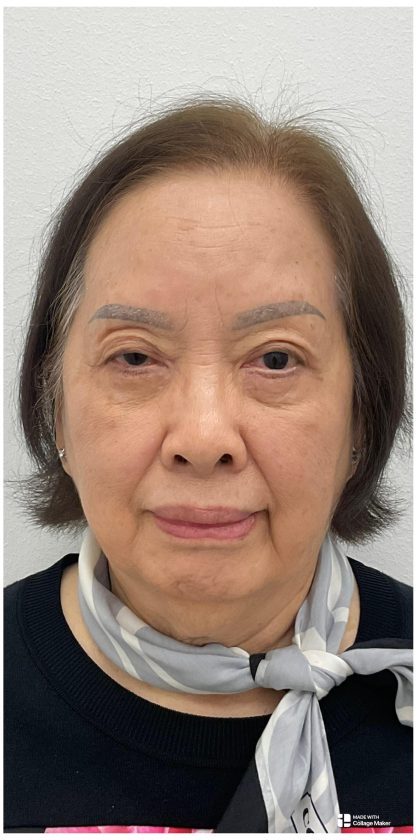 Lower Blepharoplasty Before & After Patient #4114