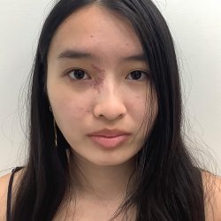 Birthmark Removal Before & After Patient #4031