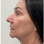 XERF Before & After Patient #4023