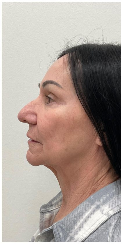 XERF Before & After Patient #4023