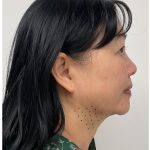Kybella Before & After Patient #3996