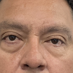 Lower Blepharoplasty Before & After Patient #4044