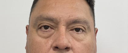 Lower Blepharoplasty Before & After Patient #4044
