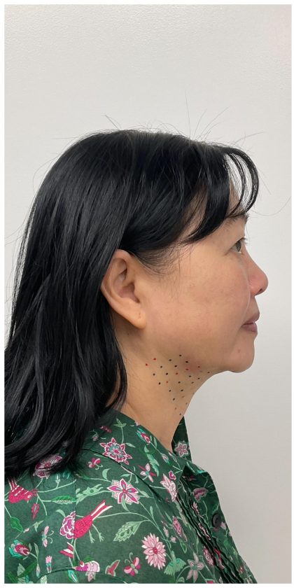 Kybella Before & After Patient #3996