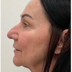 XERF Before & After Patient #4023