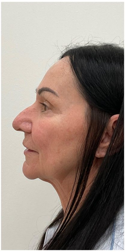 XERF Before & After Patient #4023