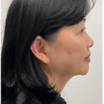 Kybella Before & After Patient #3996