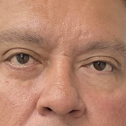 Lower Blepharoplasty Before & After Patient #4044