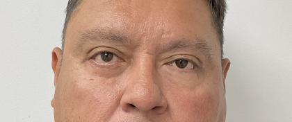 Lower Blepharoplasty Before & After Patient #4044