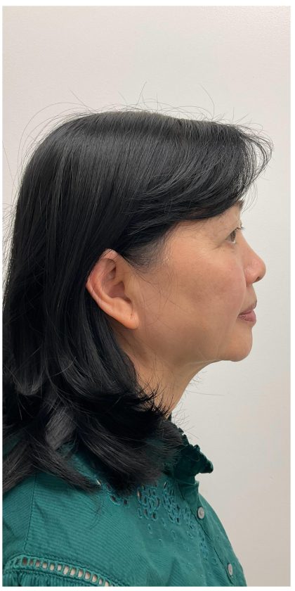 Kybella Before & After Patient #3996