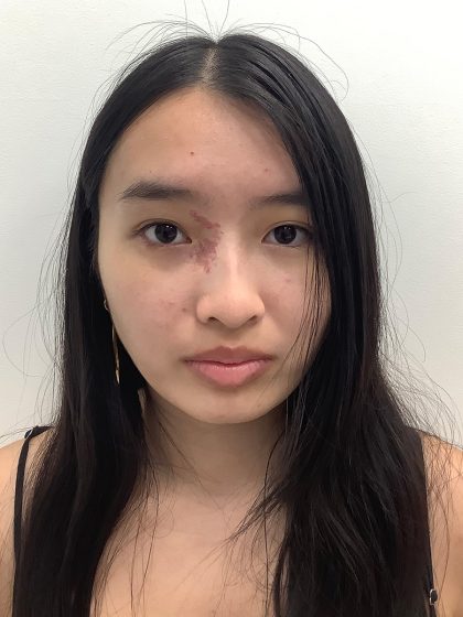 Birthmark Removal Before & After Patient #4031