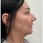 XERF Before & After Patient #4023