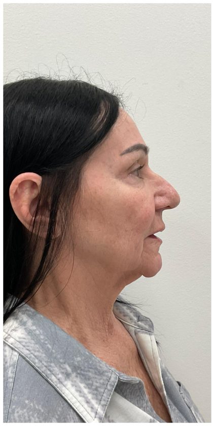 XERF Before & After Patient #4023