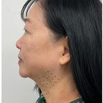 Kybella Before & After Patient #3996