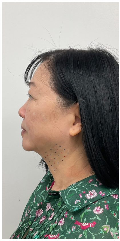 Kybella Before & After Patient #3996