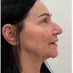 XERF Before & After Patient #4023