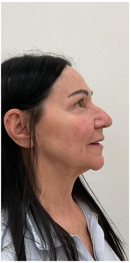 XERF Before & After Patient #4023