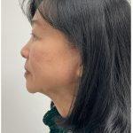 Kybella Before & After Patient #3996
