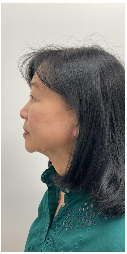 Kybella Before & After Patient #3996