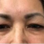 Upper Blepharoplasty Before & After Patient #4108