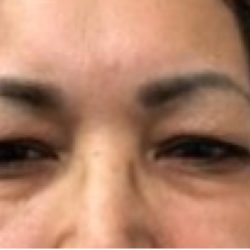 Upper Blepharoplasty Before & After Patient #4108