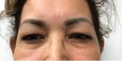 Upper Blepharoplasty Before & After Patient #4108