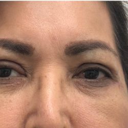 Upper Blepharoplasty Before & After Patient #4108