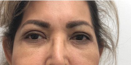 Upper Blepharoplasty Before & After Patient #4108