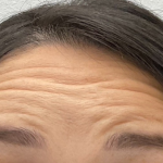 Botox Before & After Patient #4105