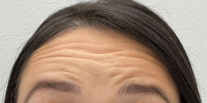 Botox Before & After Patient #4105
