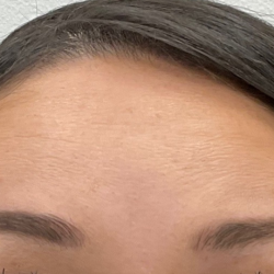 Botox Before & After Patient #4105