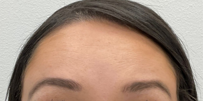 Botox Before & After Patient #4105