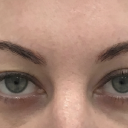 Upper Blepharoplasty Before & After Patient #4061