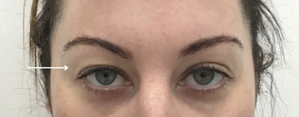 Upper Blepharoplasty Before & After Patient #4061